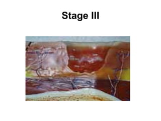 Stage III
 