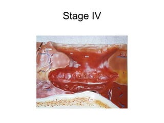 Stage IV
 