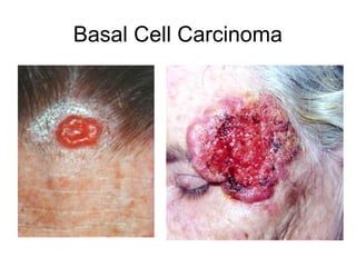 Basal Cell Carcinoma
 
