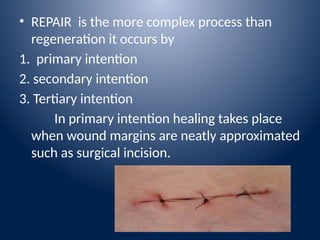 Approximated Incision Healing Ridge Process in Wound healing _ nursing .pptx