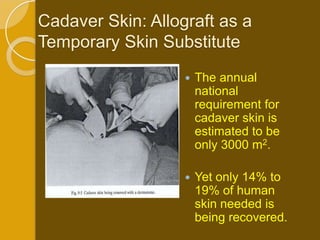Cadaver Skin: Allograft as a
Temporary Skin Substitute
                      The annual
                       national
                       requirement for
                       cadaver skin is
                       estimated to be
                       only 3000 m2.

                      Yet only 14% to
                       19% of human
                       skin needed is
                       being recovered.
 