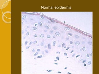 Normal epidermis
 