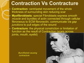 Contraction Vs Contracture
   Contraction: centripetal movement of the whole
    thickness of surrounding skin reducing scar
   Myofibroblasts: special Fibroblasts express smooth
    muscle and bundles of actin connected through cellular
    fibronexus to ECM fibronectin, communicate via gap
    junctions to pull edges of the wound
   Contracture: the physical constriction or limitation of
    function as the result of Contraction (scars across
    joints, mouth, eyelid)




         Burn/Keloid causing
         contracture
 