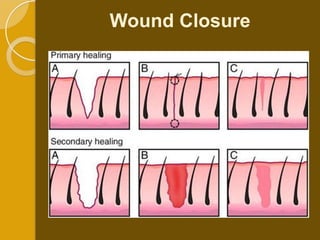 Wound Closure
 