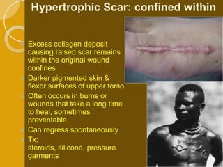 Hypertrophic Scar: confined within


 Excess collagen deposit
  causing raised scar remains
  within the original wound
  confines
 Darker pigmented skin &
  flexor surfaces of upper torso
 Often occurs in burns or
  wounds that take a long time
  to heal, sometimes
  preventable
 Can regress spontaneously
 Tx:
  steroids, silicone, pressure
  garments
 