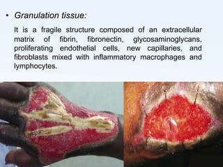 Wound healing | PPTX