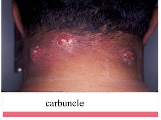 Forearm Carbuncle Wound infection ppt Dr.Mahadi | PPT