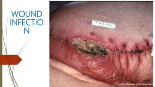 WOUND
INFECTIO
N
 