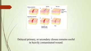 Delayed primary, or secondary closure remains useful
in heavily contaminated wound.
 