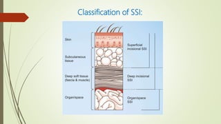 Classification of SSI:
 