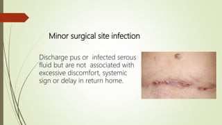 Minor surgical site infection
Discharge pus or infected serous
fluid but are not associated with
excessive discomfort, systemic
sign or delay in return home.
 