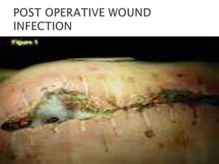 Contiguous Wound Wound infections | PPTX