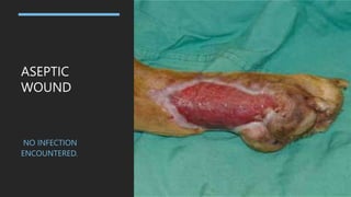 ASEPTIC
WOUND
NO INFECTION
ENCOUNTERED.
 