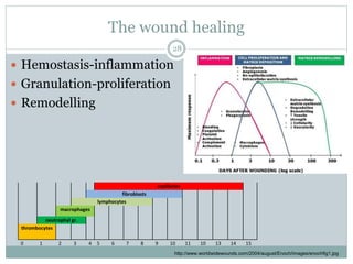 The wound healing
 Hemostasis-inflammation
 Granulation-proliferation
 Remodelling
capillaries
fibroblasts
lymphocytes
macrophages
neutrophyl gr.
thrombocytes
0 1 2 3 4 5 6 7 8 9 10 11 10 13 14 15
28
http://www.worldwidewounds.com/2004/august/Enoch/images/enochfig1.jpg
 