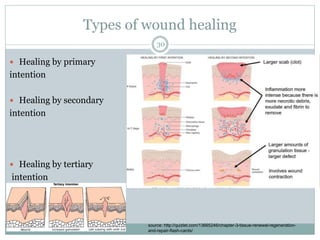 Types of wound healing
 Healing by primary
intention
 Healing by secondary
intention
 Healing by tertiary
intention
30
source: http://quizlet.com/13665246/chapter-3-tissue-renewal-regeneration-
and-repair-flash-cards/
 