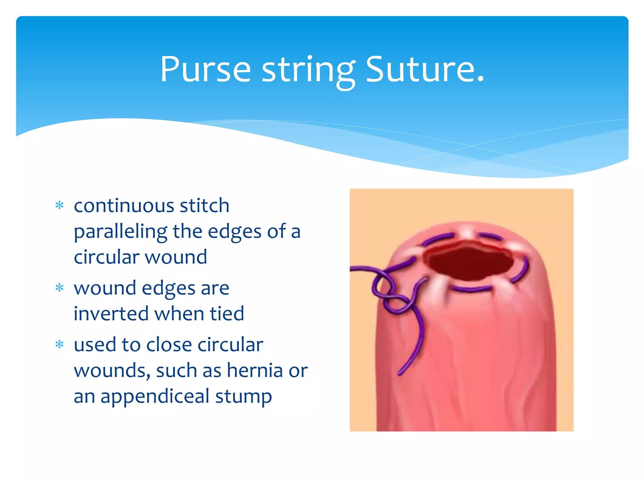 String Wounds Small Wound management | PPTX