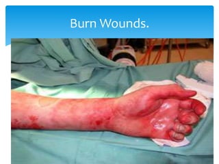 Burn Wounds.
 