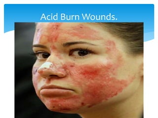Acid Burn Wounds.
 