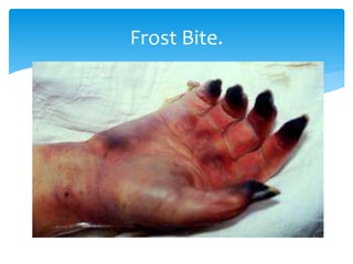Frost Bite.
 