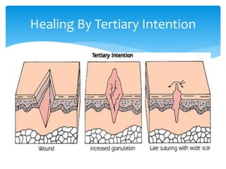 Healing By Tertiary Intention
 