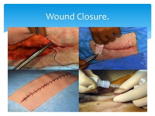 Wound Closure.
 