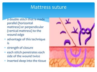 Mattress suture
 a double stitch that is made
parallel (horizontal
mattress) or perpendicular
(vertical mattress) to the
wound edge
 advantage of this technique
is
 strength of closure
 each stitch penetrates each
side of the wound twice
 inserted deep into the tissue
 