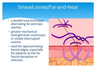 Smead-Jones/Far-and-Near
 a double loop technique
alternating far and near
stitches
 greater mechanical
strength than continuous
or simple interrupted
sutures
 used for approximating
fascial edges, especially
for patients at risk for
fascial disruption or
infection
 