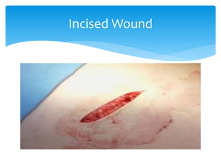Incised Wound
 