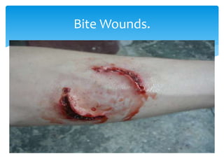 Bite Wounds.
 