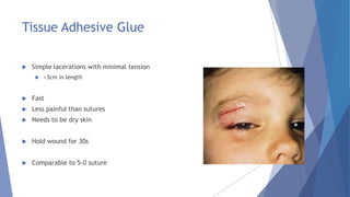 Tissue Adhesive Glue
 Simple lacerations with minimal tension
 <3cm in length
 Fast
 Less painful than sutures
 Needs to be dry skin
 Hold wound for 30s
 Comparable to 5-0 suture
 