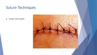 Suture Techniques
 Simple interrupted
 