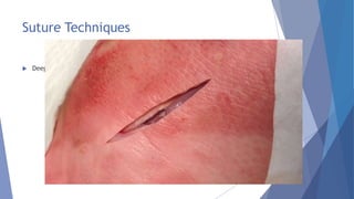 Suture Techniques
 Deep Dermal Suture
 