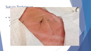 Suture Techniques
 Vertical Mattress
 Useful in areas of high tension (e.g. shin)
 Can lead to ischaemia around wound edges
 