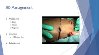 ED Management
 Anaesthesia
 Local
 Topical
 Regional
 Irrigation
 ~100ml per 1cm
 Debridement
 