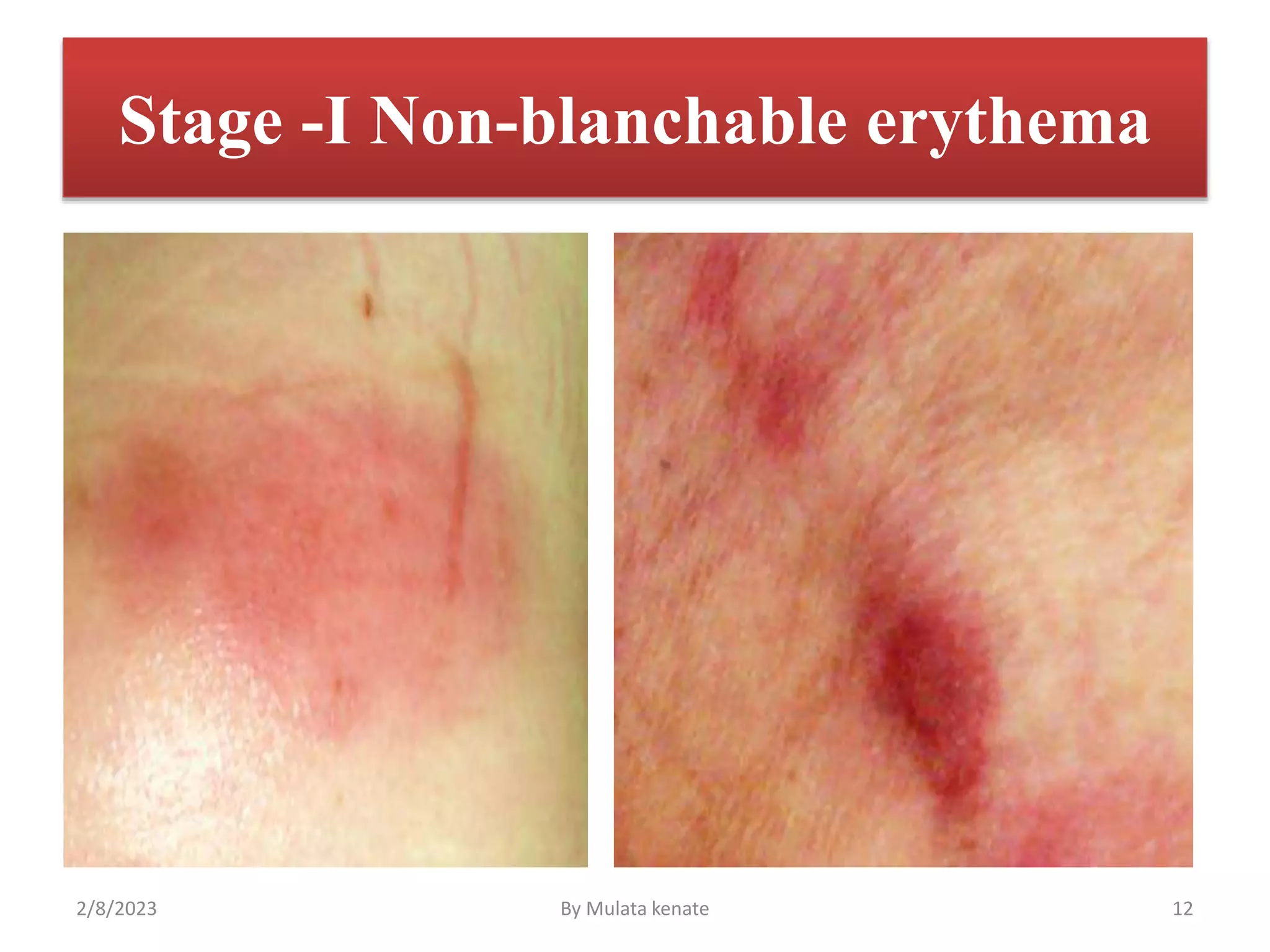 Wound management.pptx