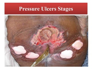 Pressure Ulcers Stages
2/8/2023 By Mulata kenate 10
 
