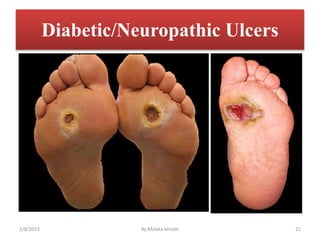 Diabetic/Neuropathic Ulcers
2/8/2023 By Mulata kenate 21
 