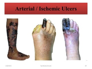 Arterial / Ischemic Ulcers
2/8/2023 By Mulata kenate 34
 