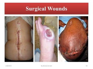Surgical Wounds
2/8/2023 By Mulata kenate 44
 
