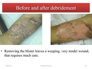 Before and after debridement
• Removing the blister leaves a weeping, very tender wound,
that requires much care.
2/8/2023...