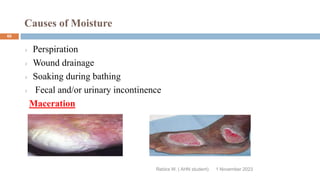 Causes of Moisture
Rebira W. ( AHN student)
Perspiration
Wound drainage
Soaking during bathing
Fecal and/or urinary incontinence
Maceration
1 November 2023
60
 