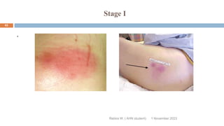 Stage I
Rebira W. ( AHN student)
.
1 November 2023
62
 