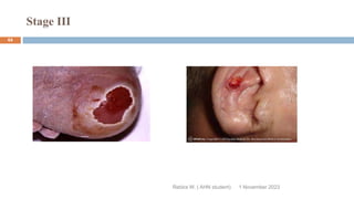 Stage III
Rebira W. ( AHN student) 1 November 2023
64
 