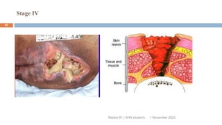 Stage IV
Rebira W. ( AHN student) 1 November 2023
65
 