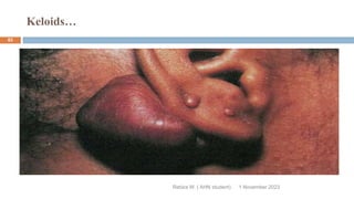 Keloids…
Rebira W. ( AHN student) 1 November 2023
83
 