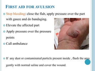 FIRST AID FOR AVULSION
 Stop bleeding: close the flab, apply pressure over the part
with gauze and do bandaging.
 Elevate the affected part
 Apply pressure over the pressure
points
 Call ambulance
 If any dust or contaminated particle present inside , flush the area
gently with normal saline and cover the wound.
 