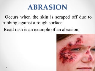 ABRASION
Occurs when the skin is scraped off due to
rubbing against a rough surface.
Road rash is an example of an abrasion.
 