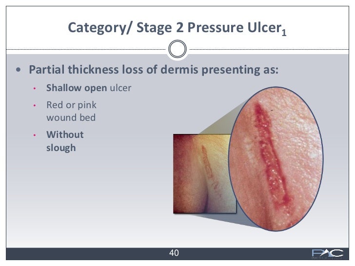 skin pressure sores symptoms and guidelines Every pressure sore seen on the skin stages of pressure sores stage 1 signs: skin is not broken but is red or discolored or may show changes in hardness or. skin pressure sores symptoms and guidelines Every pressure sore seen on the skin stages of pressure sores stage 1 signs: skin is not broken but is red or discolored or may show changes in hardness or.
