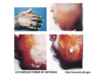 CUTANEOUS FORMS OF ANTHRAX  http://www.bt.cdc.gov 