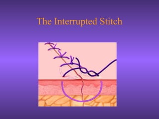 The Interrupted Stitch
 